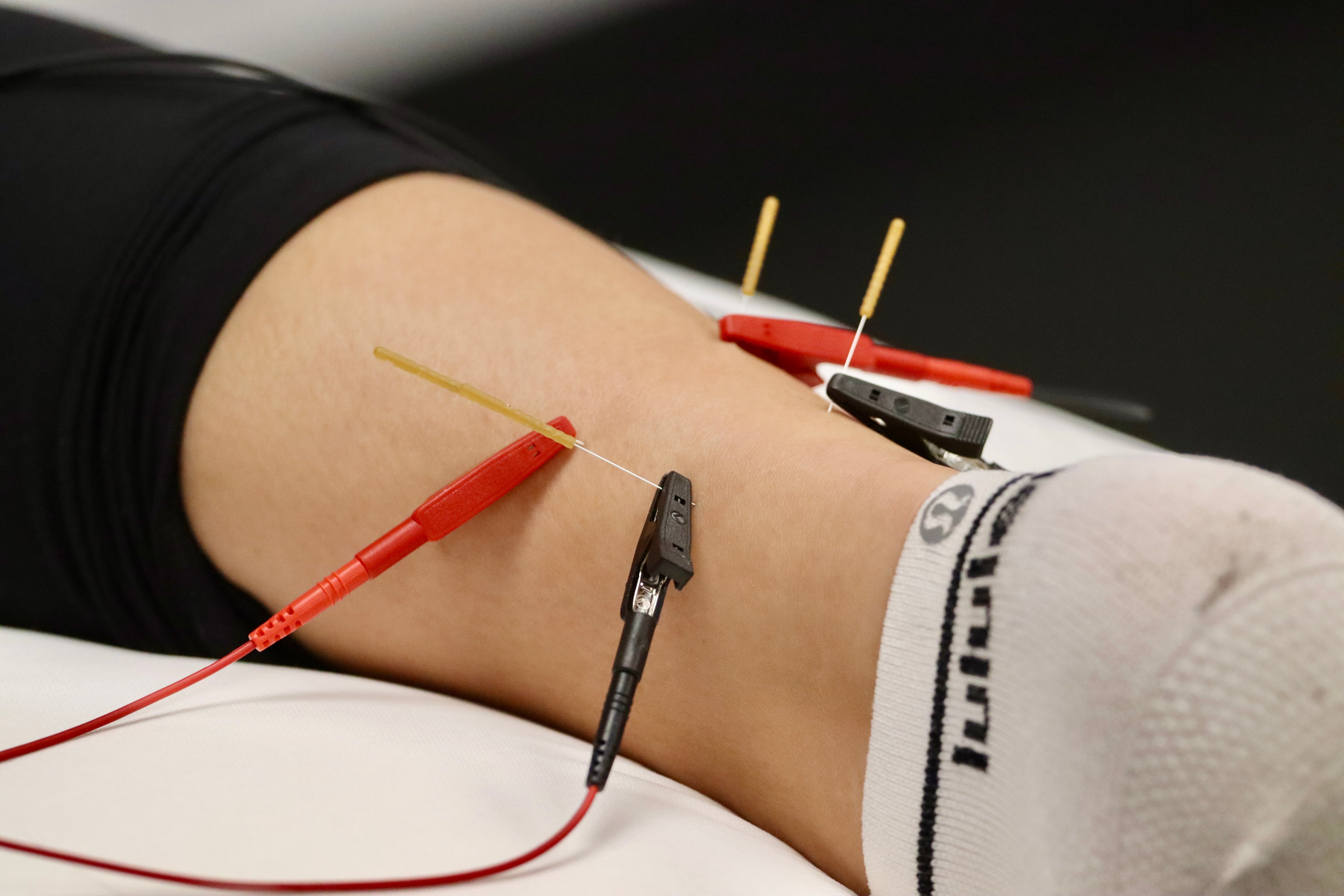 A person's calf being dry needled with calipers for electrical stimulation attached
