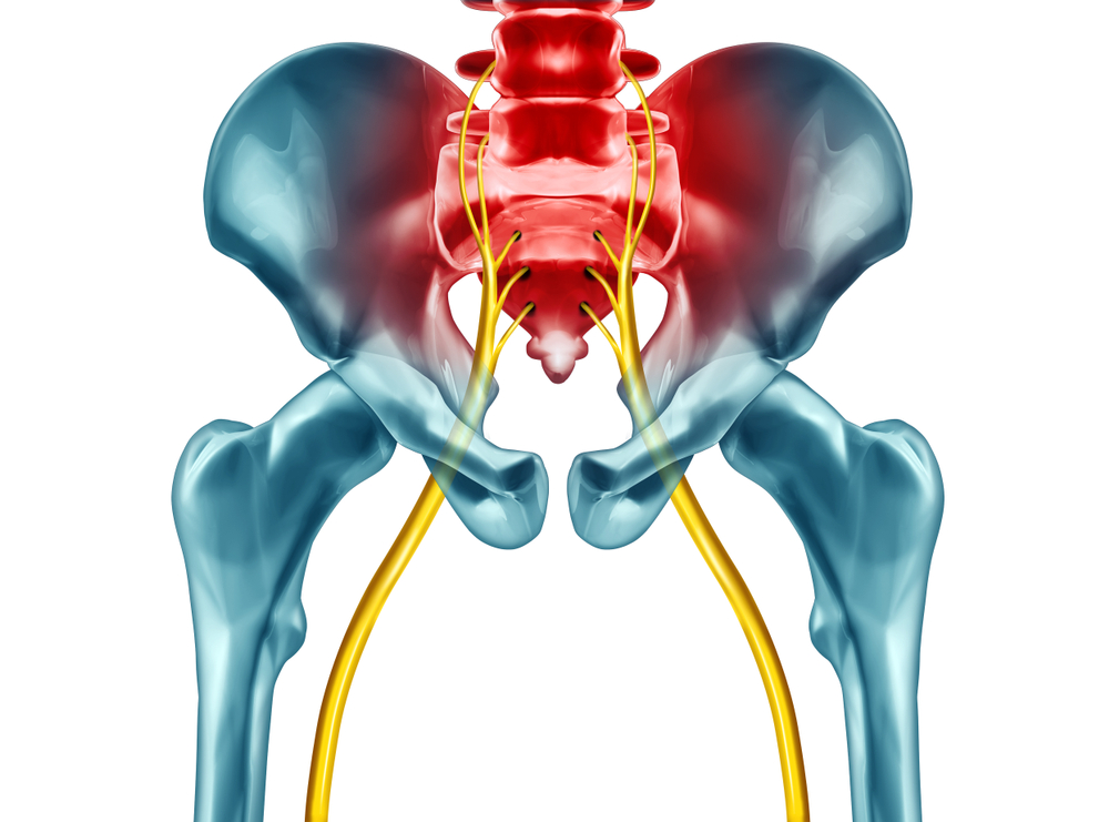 Graphic depicting sciatica